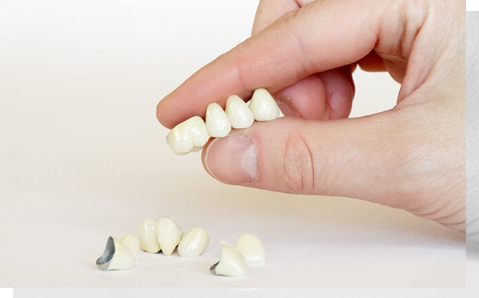 What are Dental Crowns?